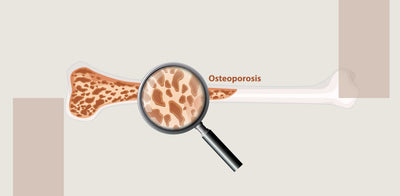 Osteoporosis & Obesity - The Dual Burden