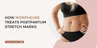 How Morpheus8 Treats Postpartum Stretch Marks: A Revolutionary Solution for New Moms